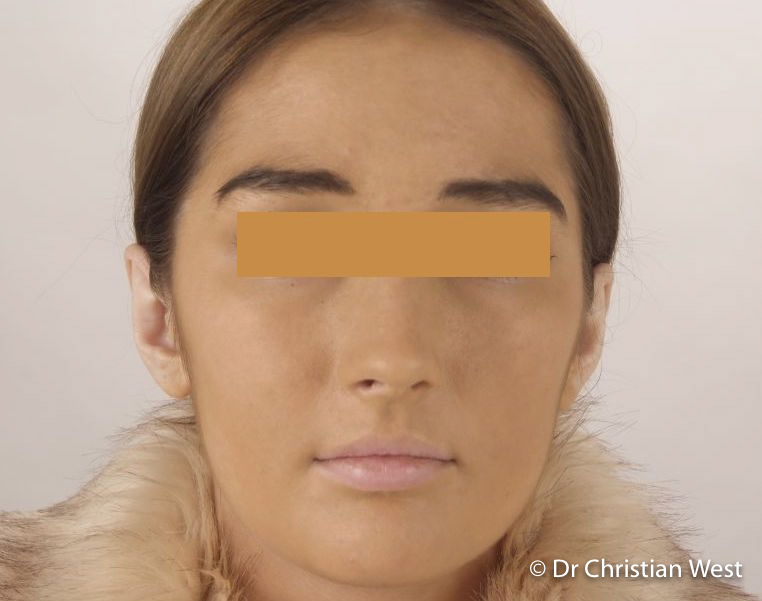 Breast-Reduction-surgery-Christian-West