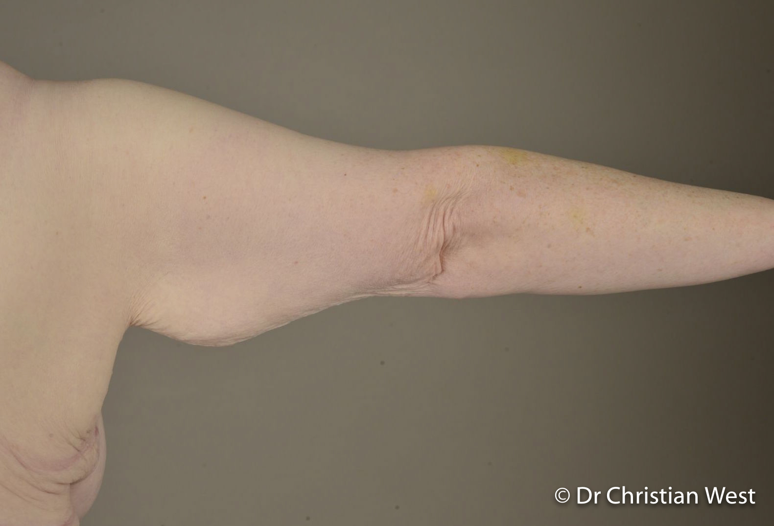 Breast-Reduction-surgery-Christian-West
