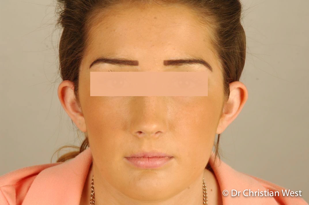 Ear-Reshaping-Surgery-Dr-Christian-West