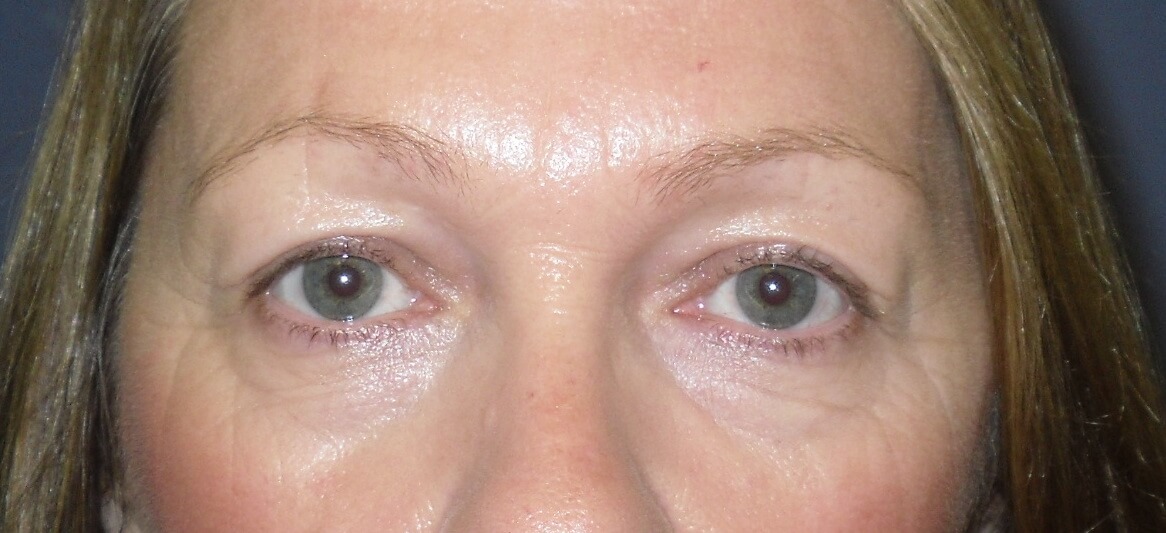 Upper Eyelid Surgery - After- Christian West