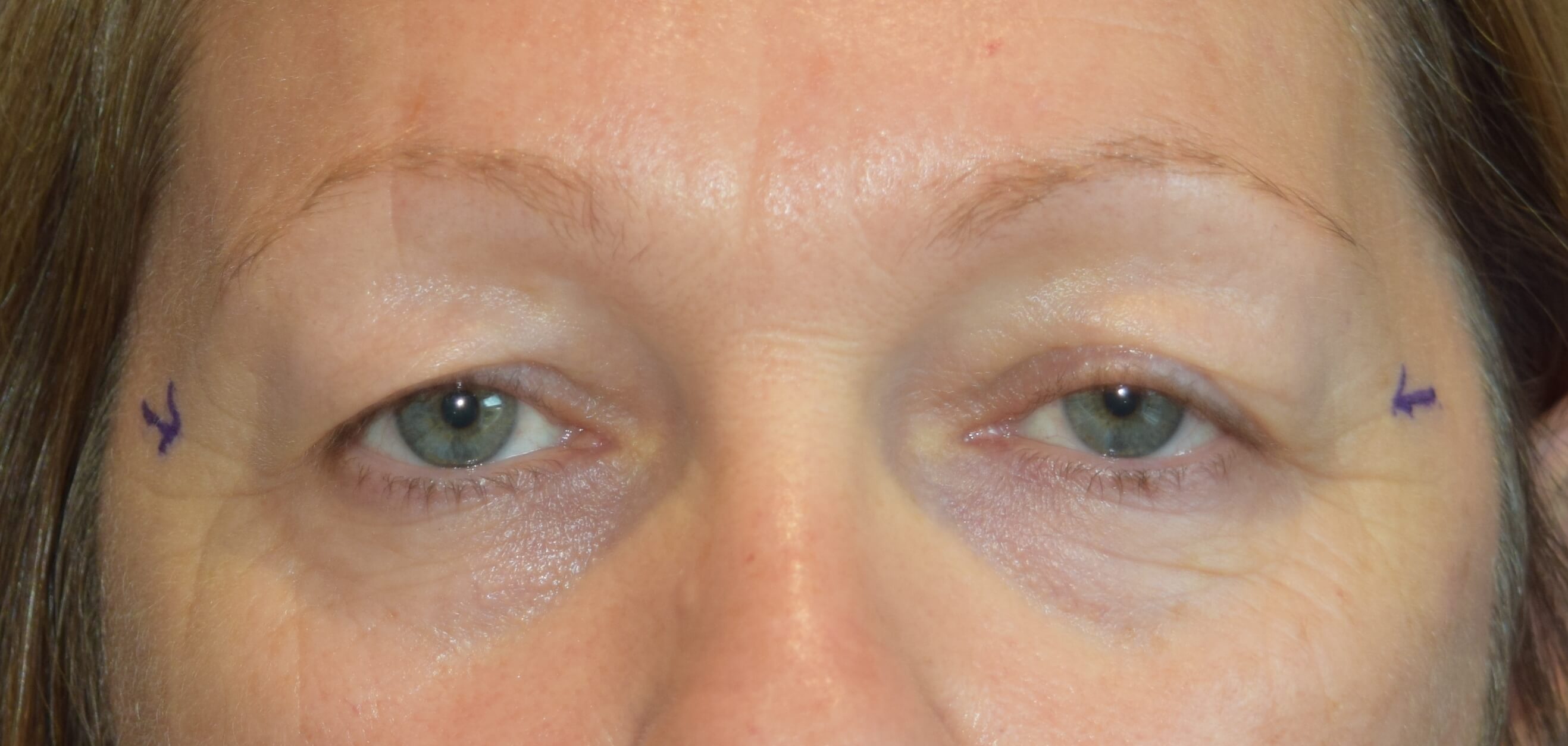 Upper Eyelid Surgery - Before- Christian West