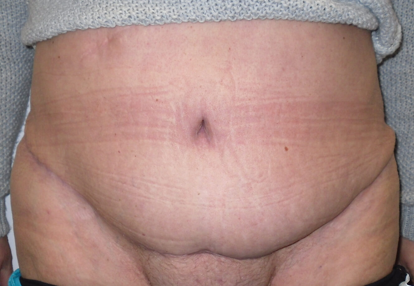 Tummy Tuck & Abdominoplasty