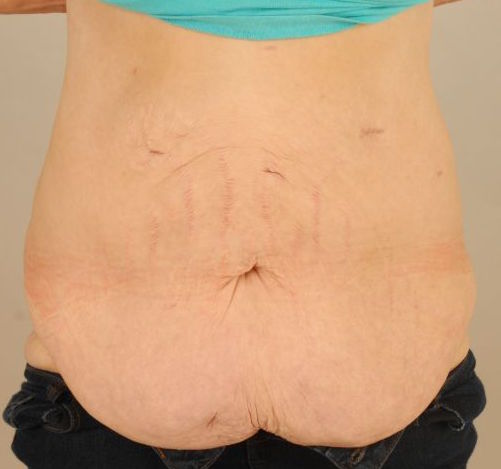 Tummy Tuck & Abdominoplasty Christian-West