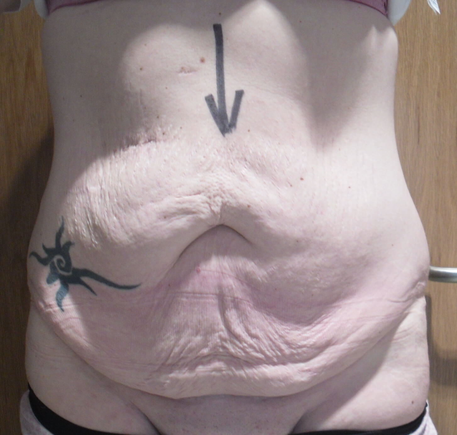 Tummy Tuck & Abdominoplasty Christian-West
