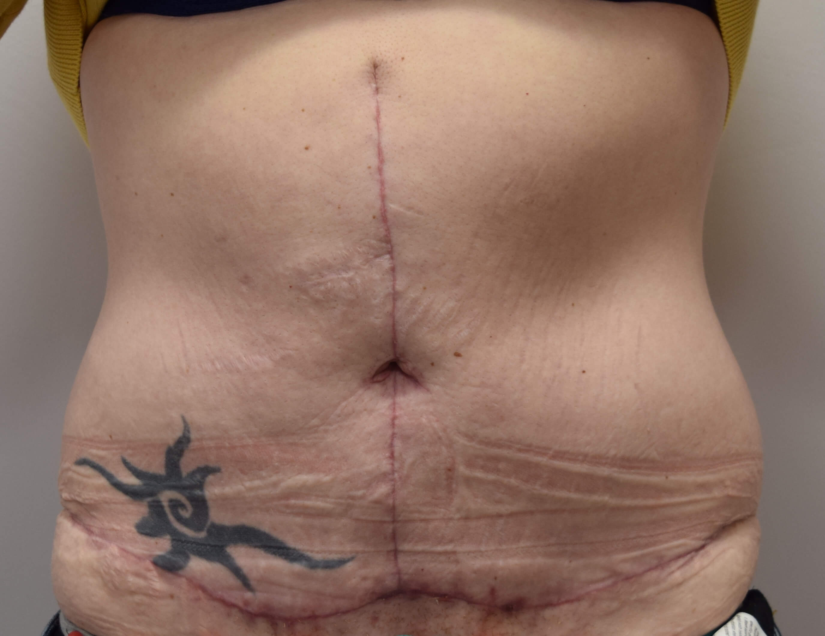 Tummy Tuck & Abdominoplasty