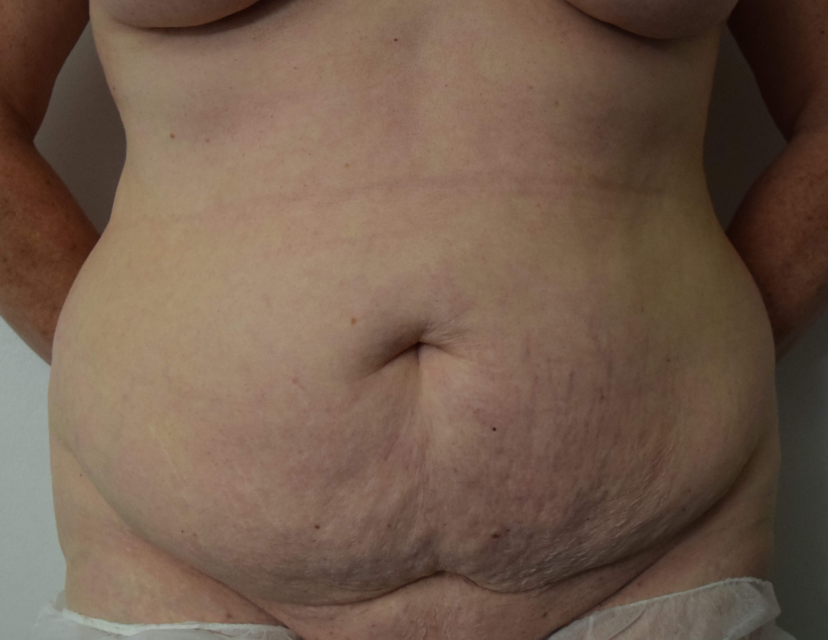 Tummy Tuck & Abdominoplasty Christian-West