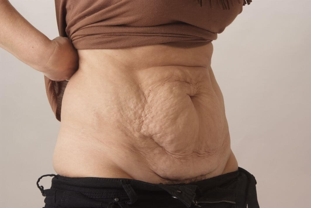 Tummy Tuck & Abdominoplasty Christian-West