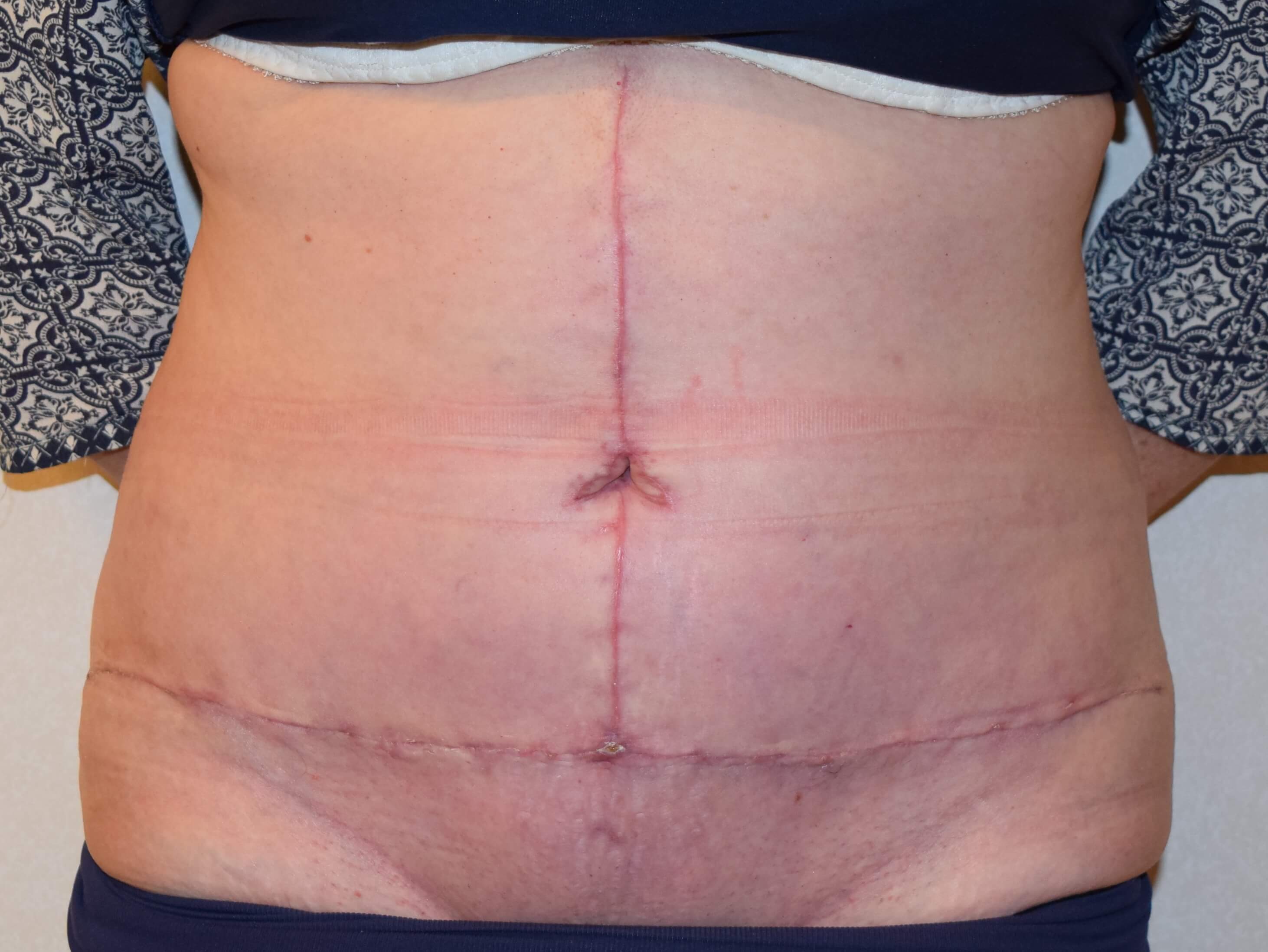 Tummy Tuck & Abdominoplasty