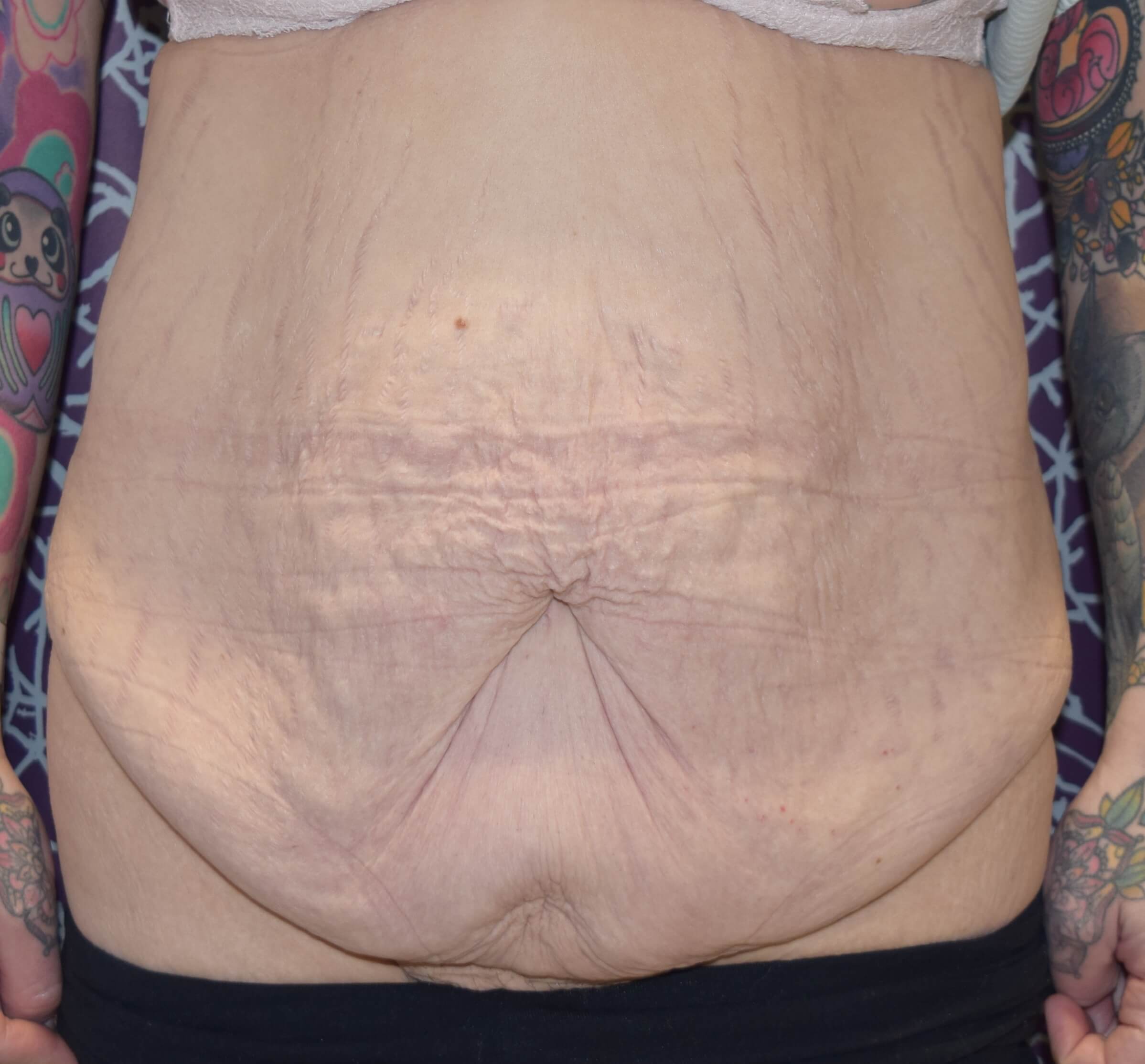 Tummy Tuck & Abdominoplasty Christian-West
