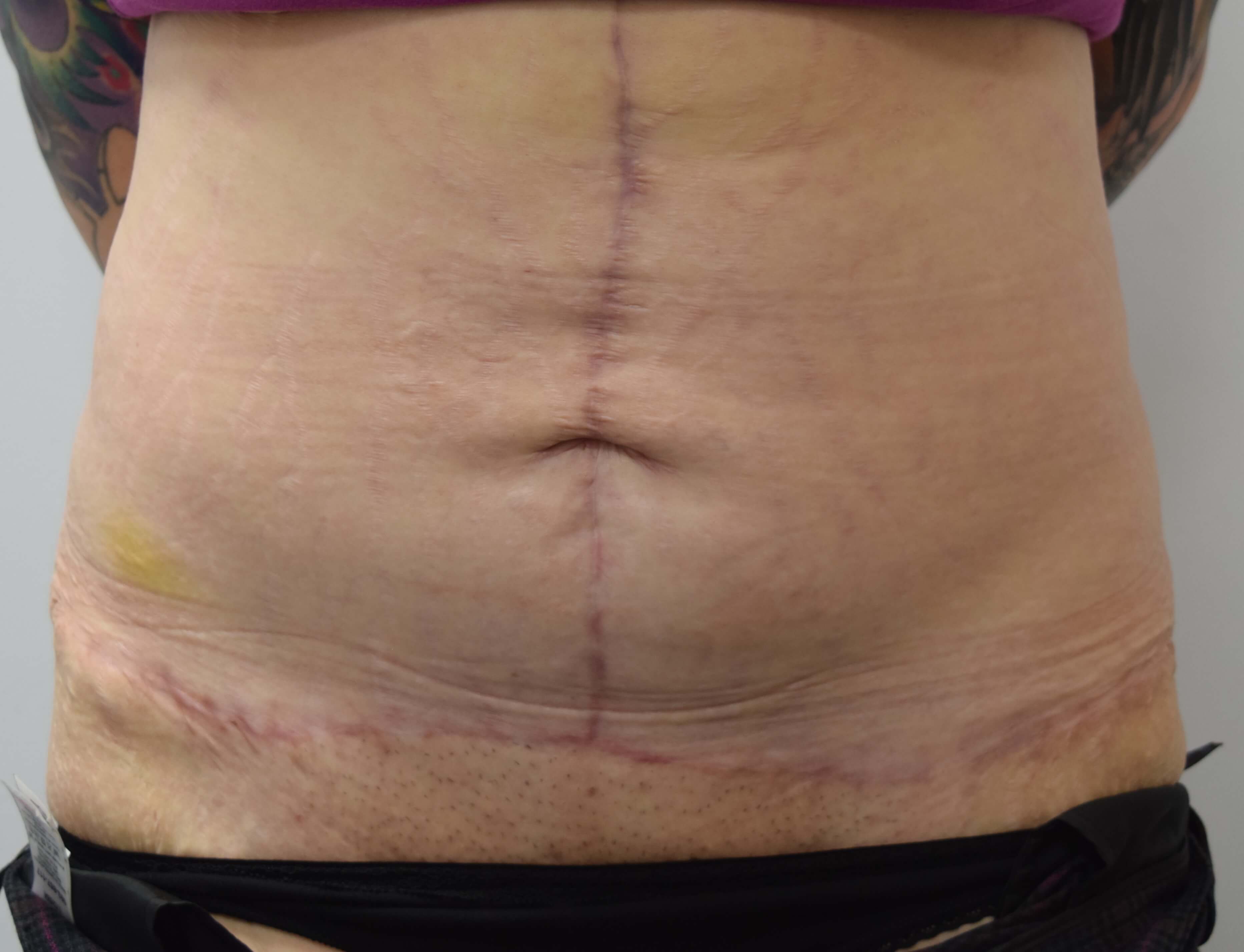 Tummy Tuck & Abdominoplasty