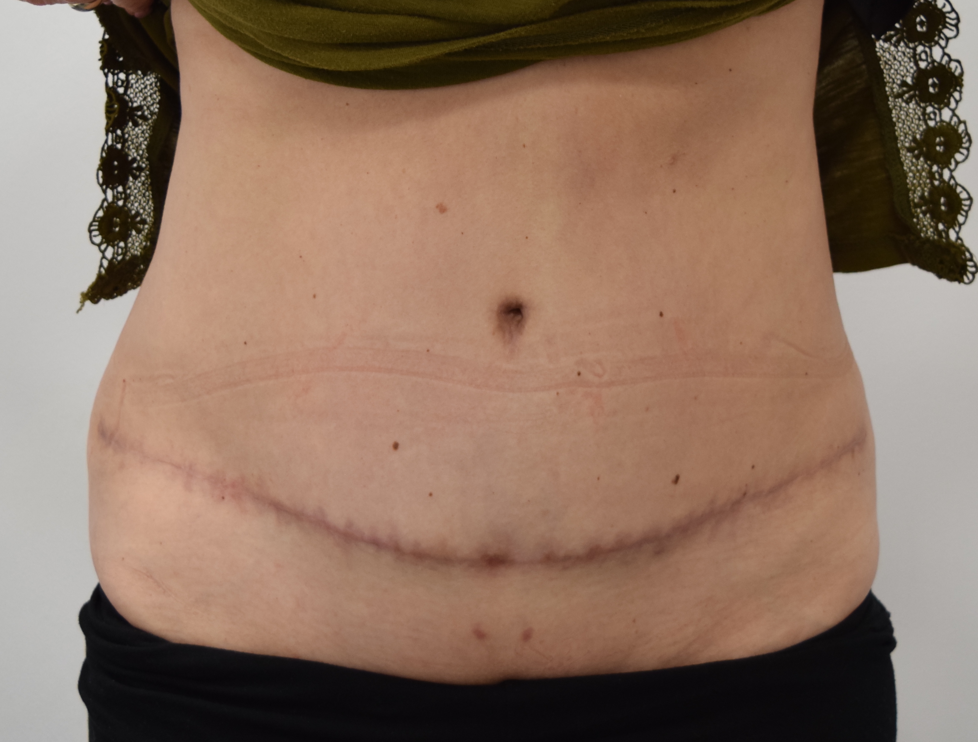 Tummy Tuck & Abdominoplasty