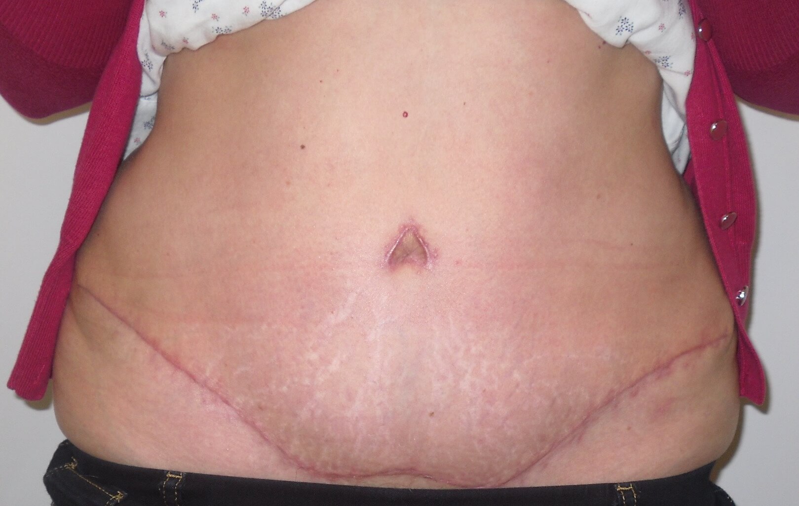 Tummy Tuck & Abdominoplasty