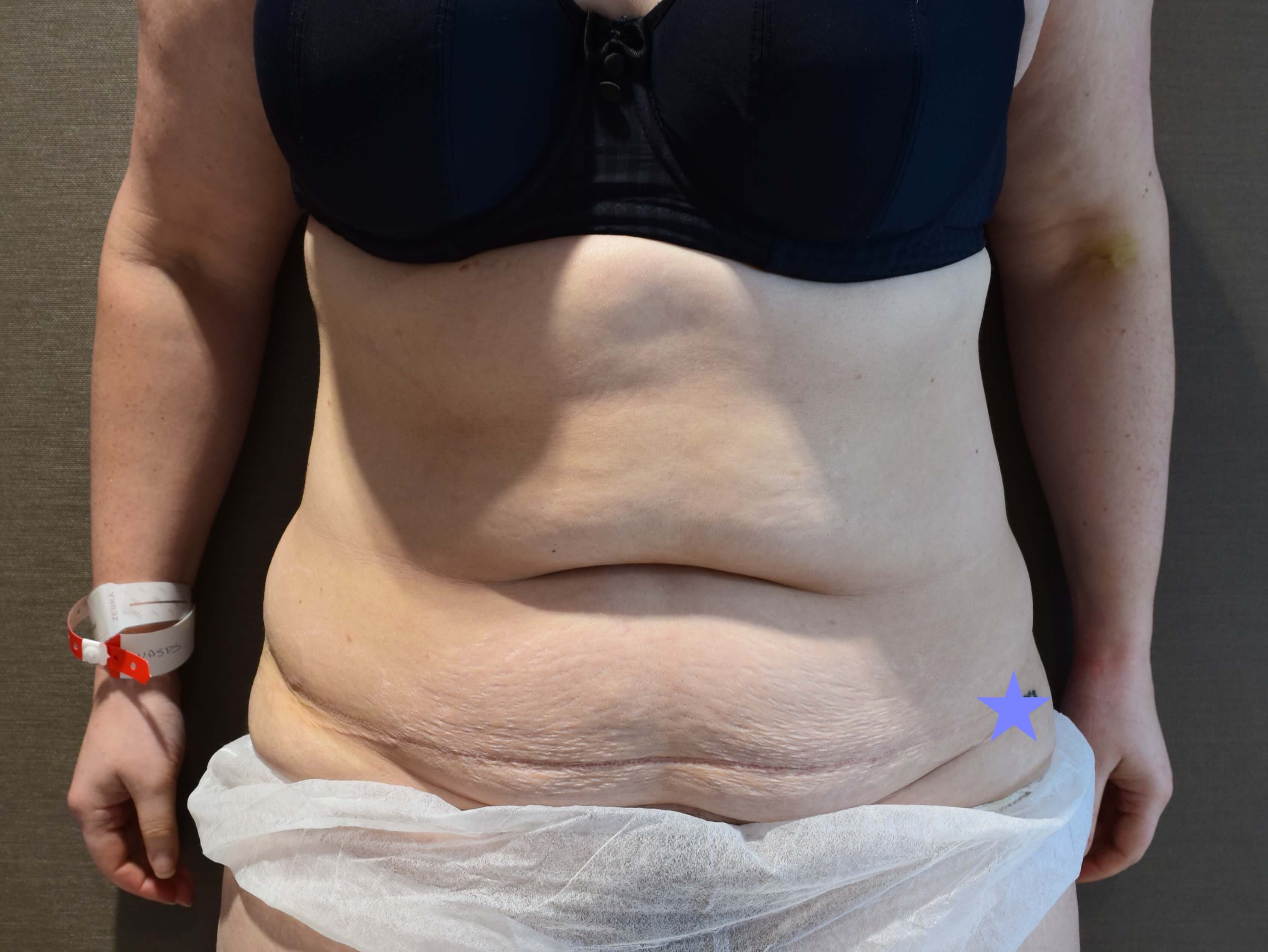 Tummy Tuck & Abdominoplasty Christian-West