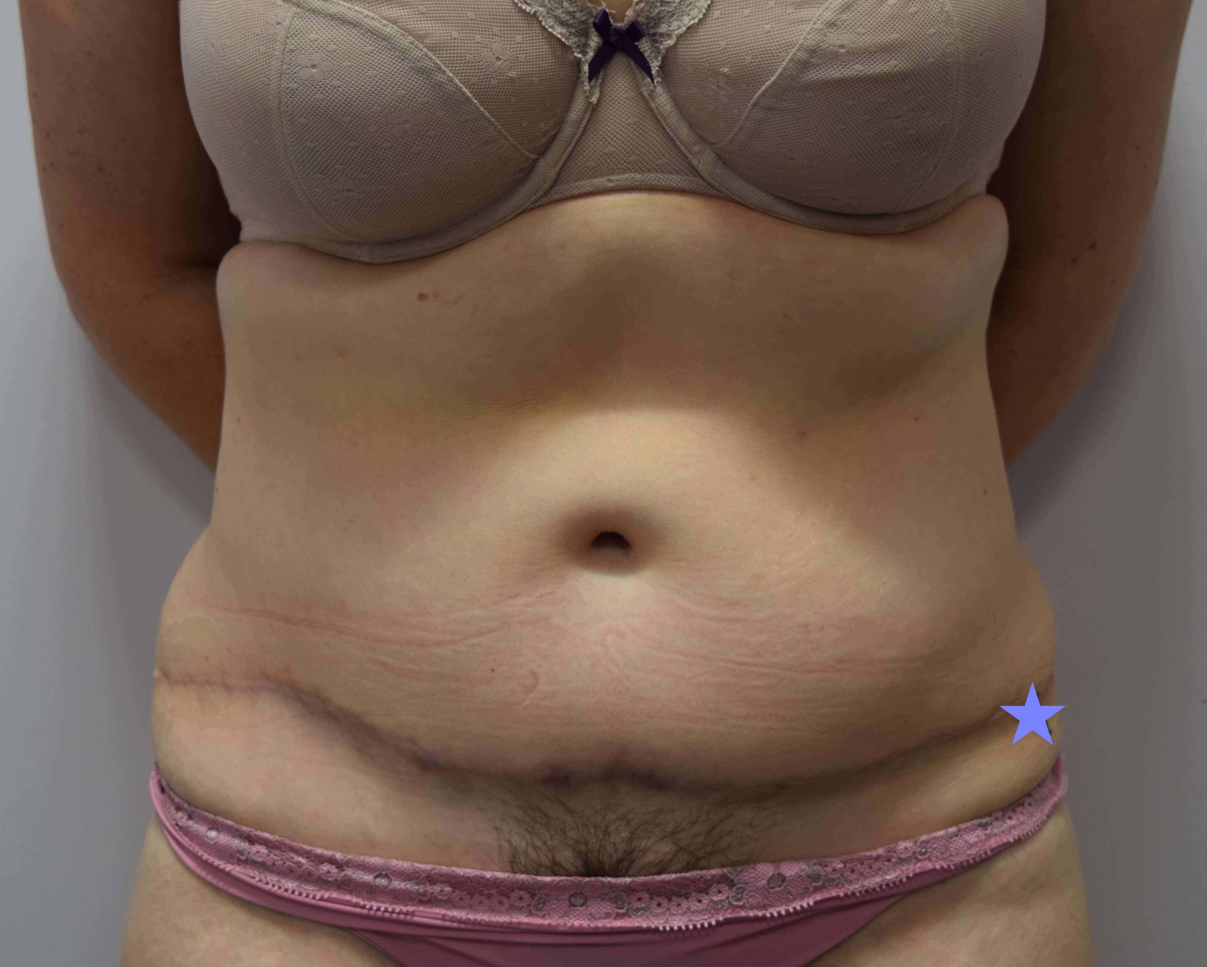 Tummy Tuck & Abdominoplasty
