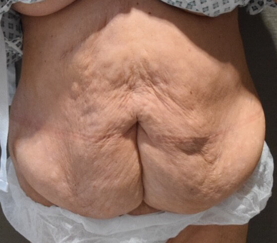 Tummy Tuck & Abdominoplasty Christian-West