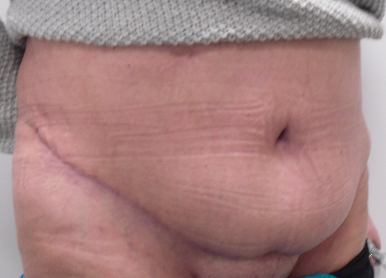 Tummy Tuck & Abdominoplasty Christian West