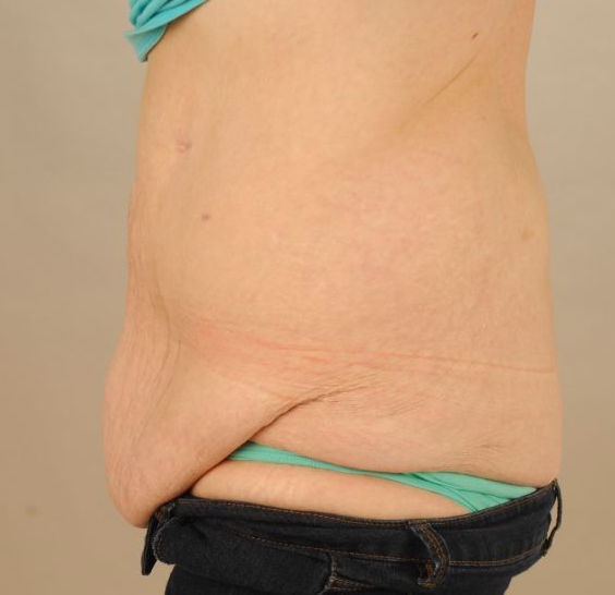 Before Tummy Tuck & Abdominoplasty Christian-West