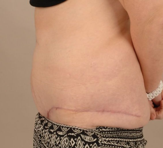 Tummy Tuck & Abdominoplasty Christian West