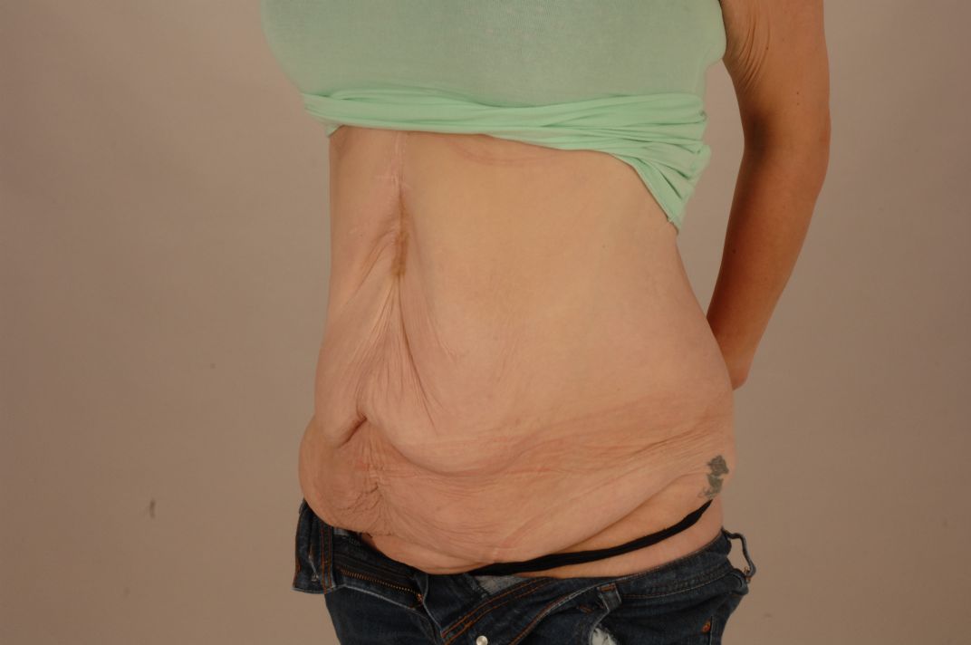 Before Tummy Tuck & Abdominoplasty Christian-West