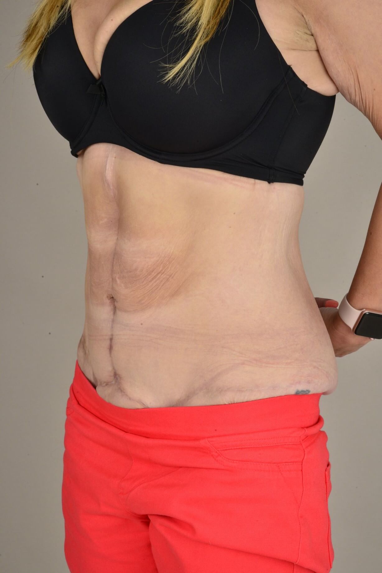 Tummy Tuck & Abdominoplasty Christian West