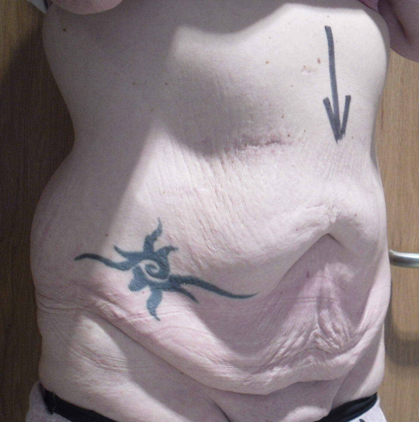 Before Tummy Tuck & Abdominoplasty Christian-West