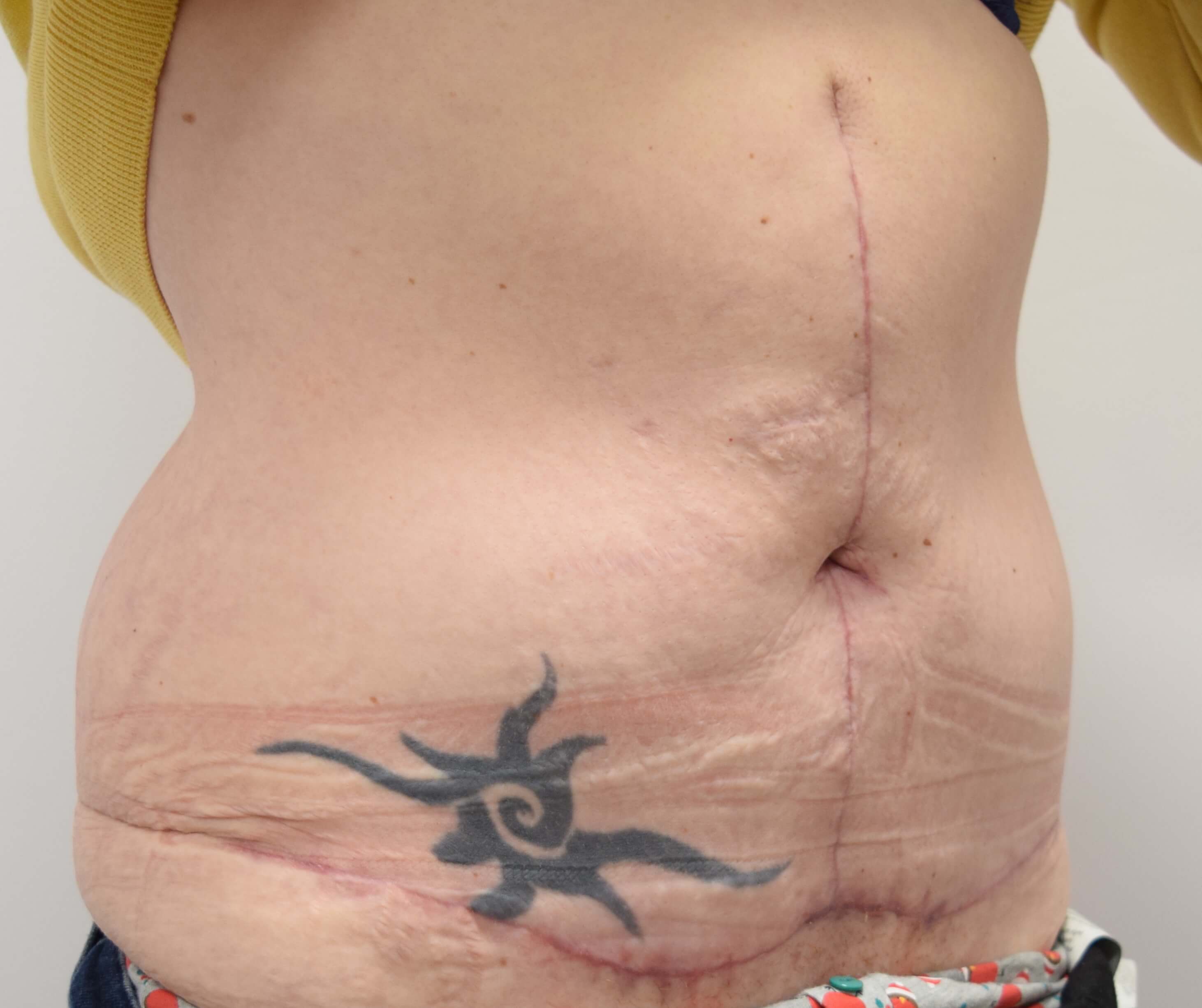 Tummy Tuck & Abdominoplasty Christian West