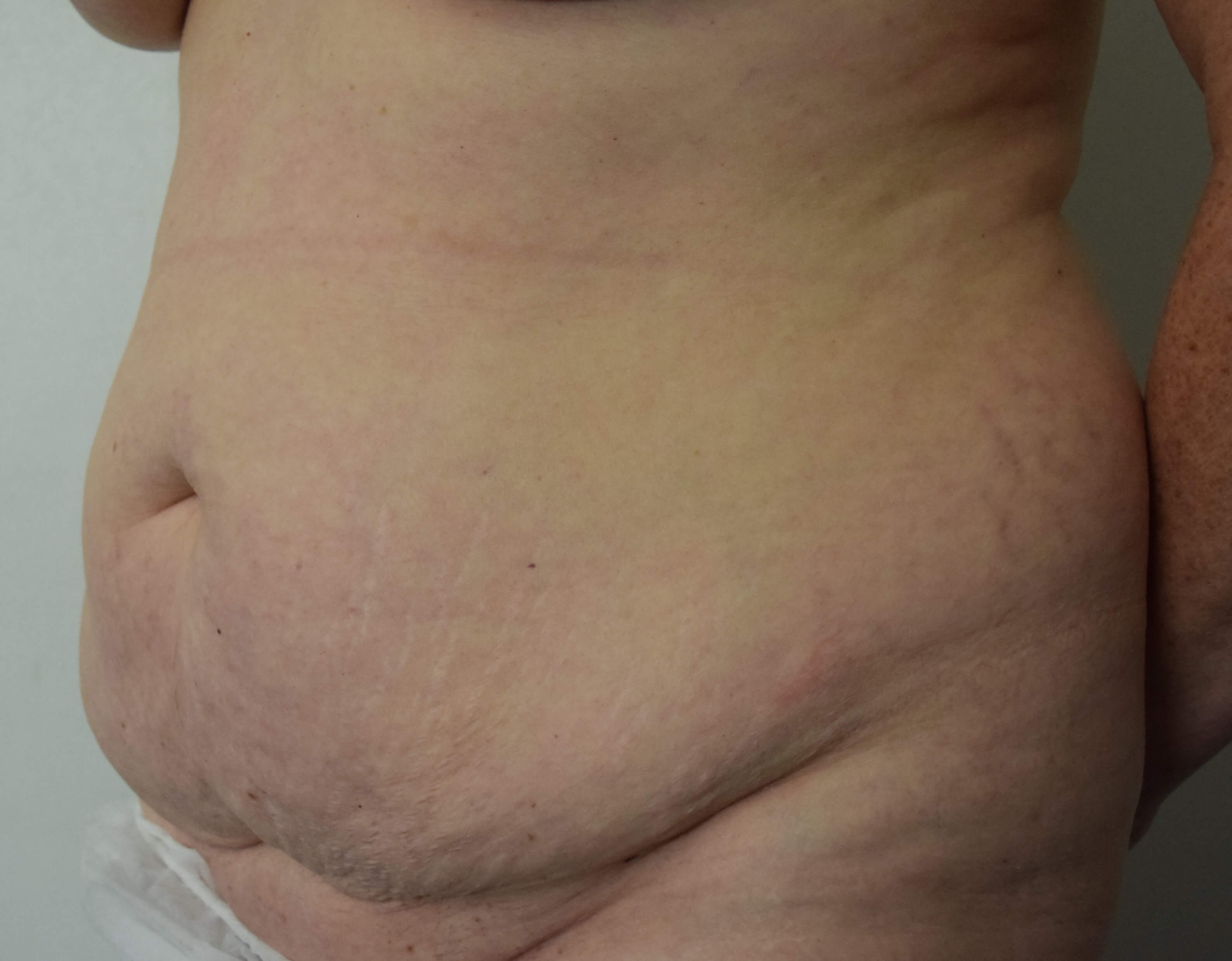 Before Tummy Tuck & Abdominoplasty Christian-West