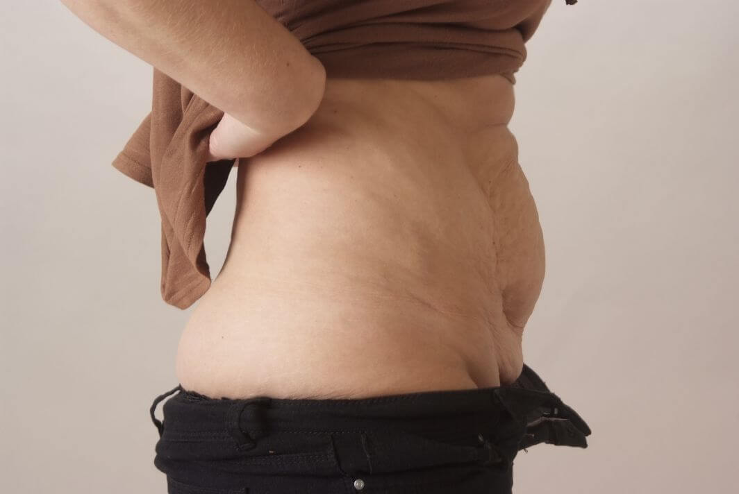 Before Tummy Tuck & Abdominoplasty Christian-West