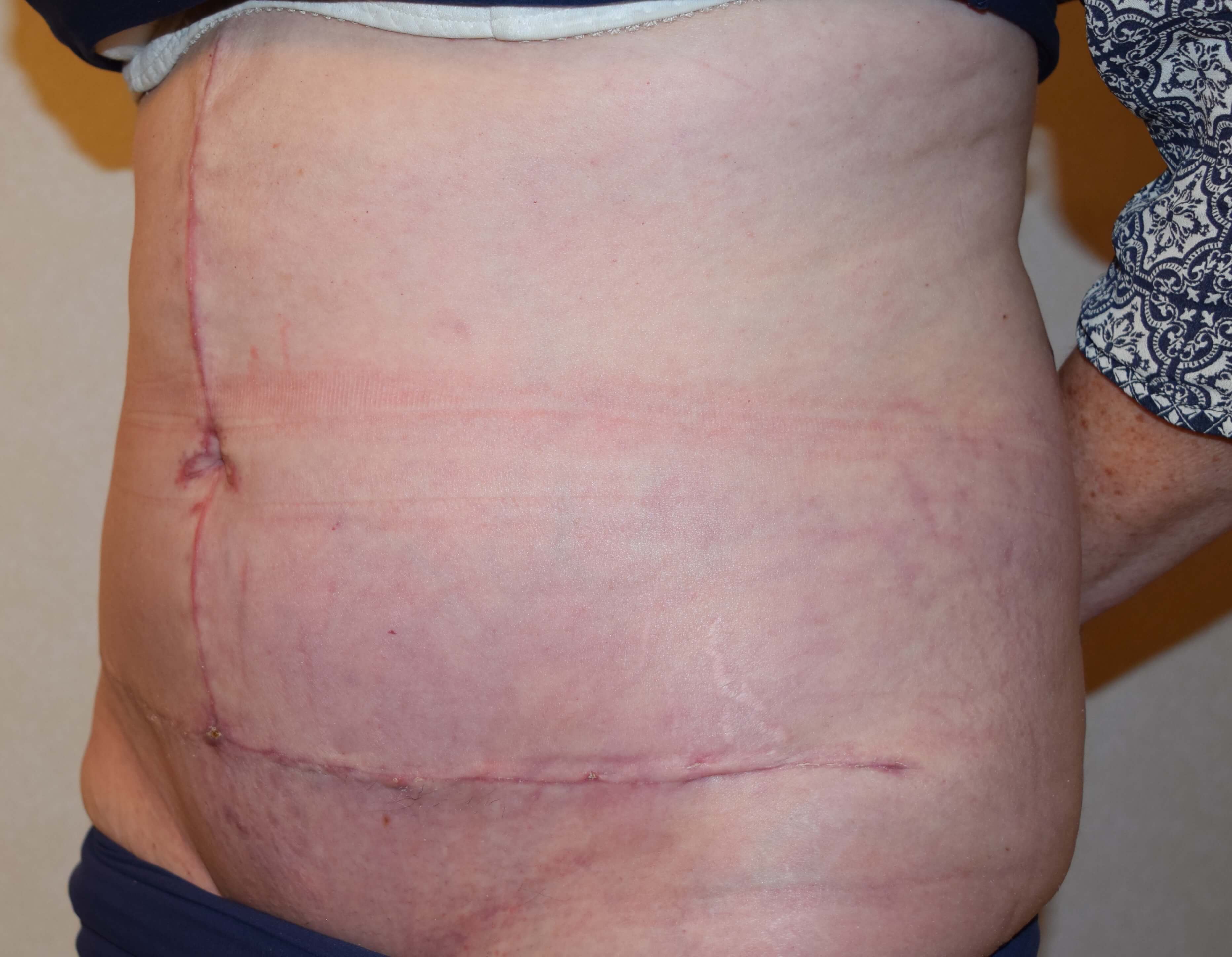 Tummy Tuck & Abdominoplasty Christian West