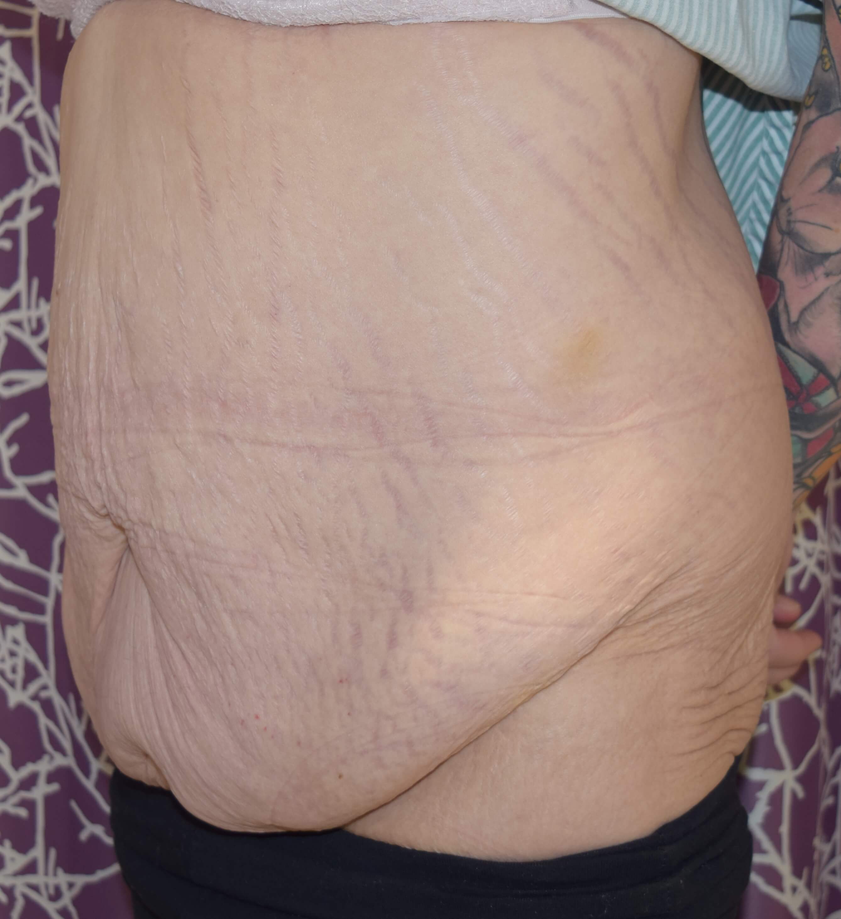 Before Tummy Tuck & Abdominoplasty Christian-West