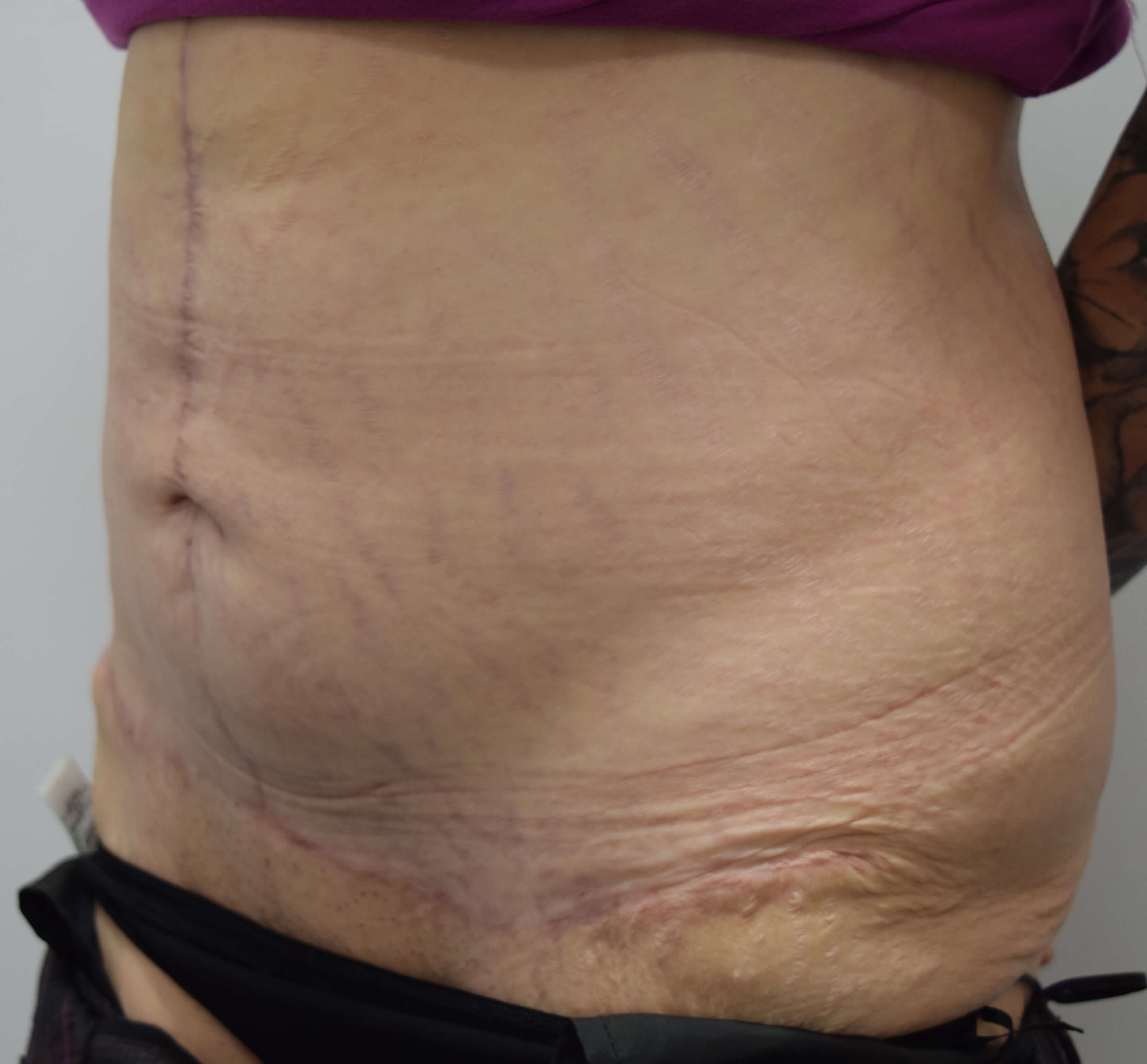 Tummy Tuck & Abdominoplasty Christian West
