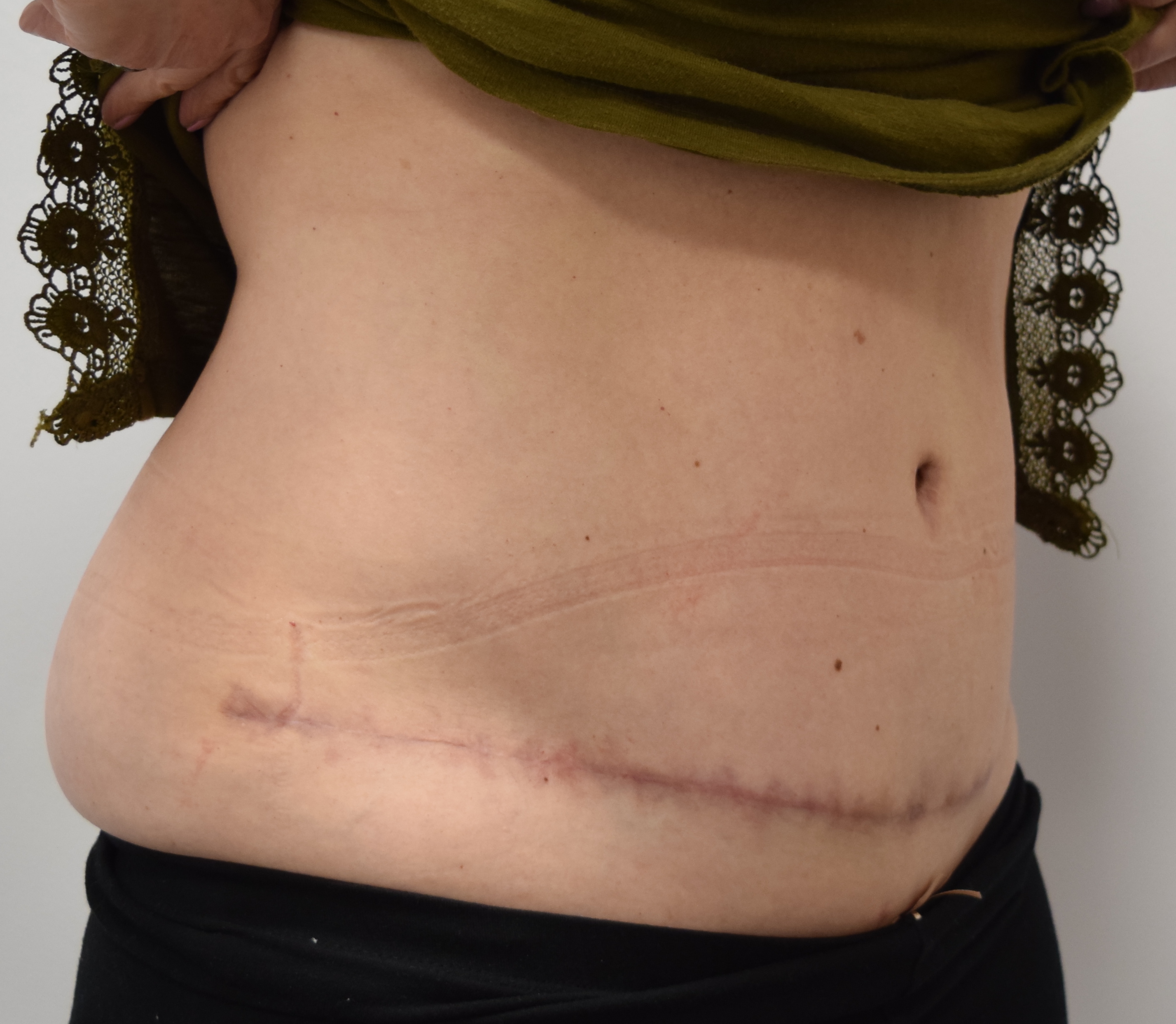Tummy Tuck & Abdominoplasty Christian West
