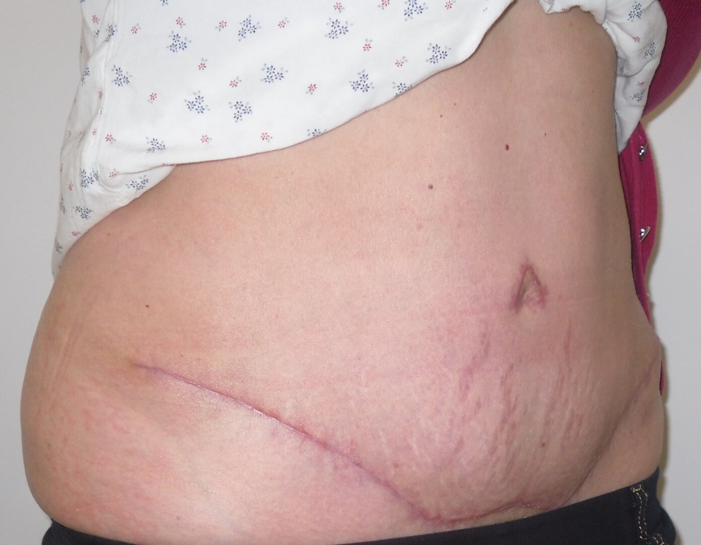 Tummy Tuck & Abdominoplasty Christian West