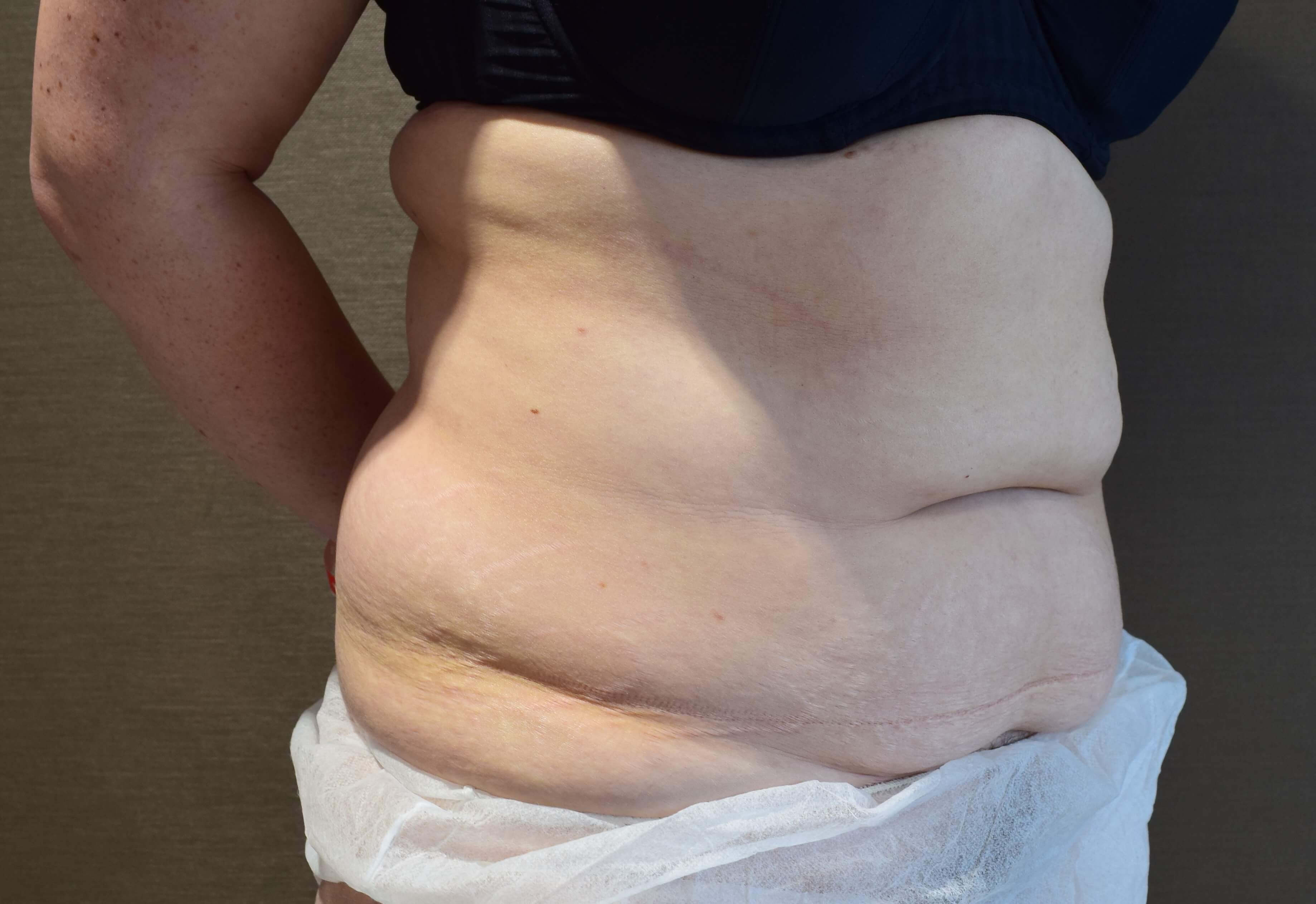 Before Tummy Tuck & Abdominoplasty Christian-West
