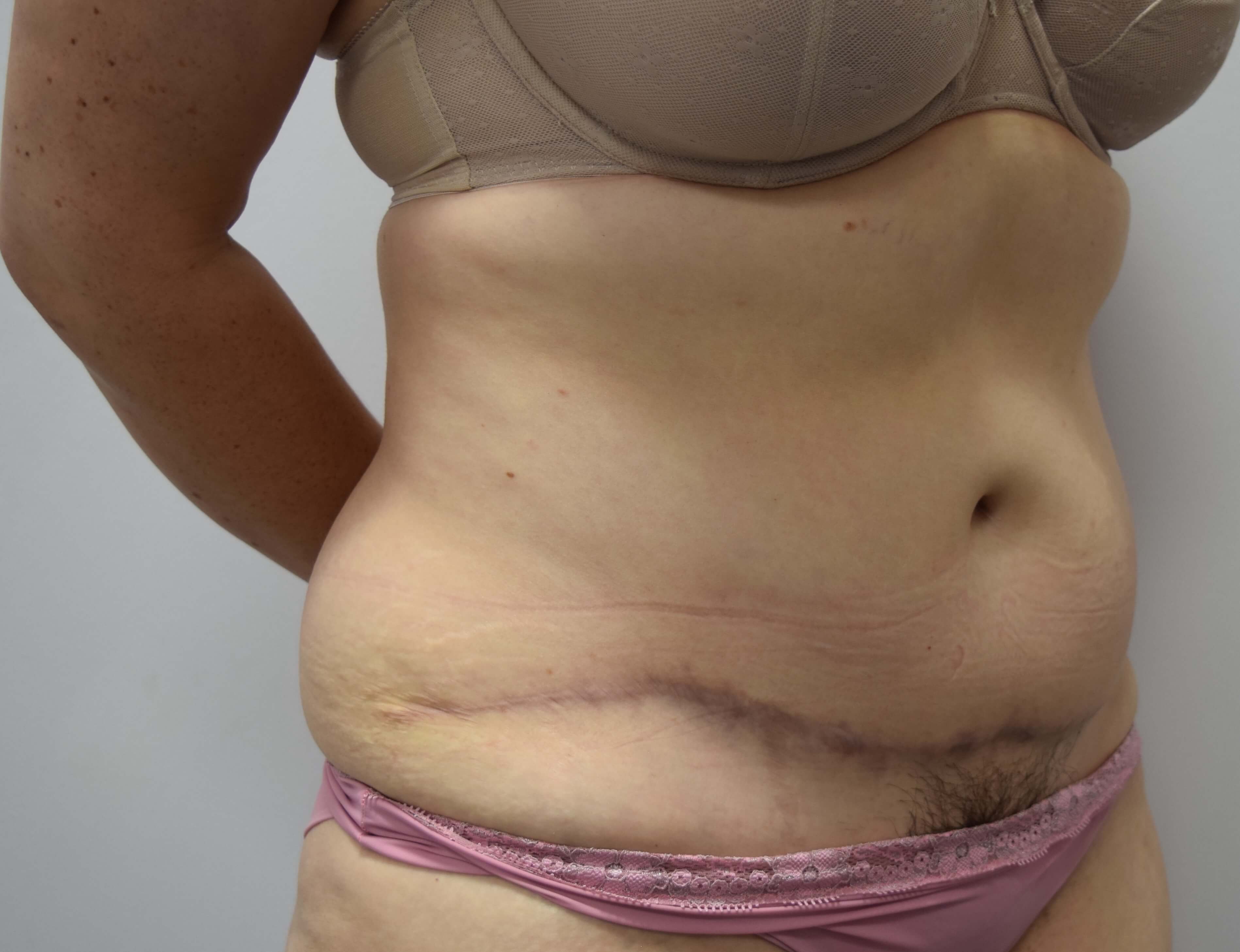 Tummy Tuck & Abdominoplasty Christian West