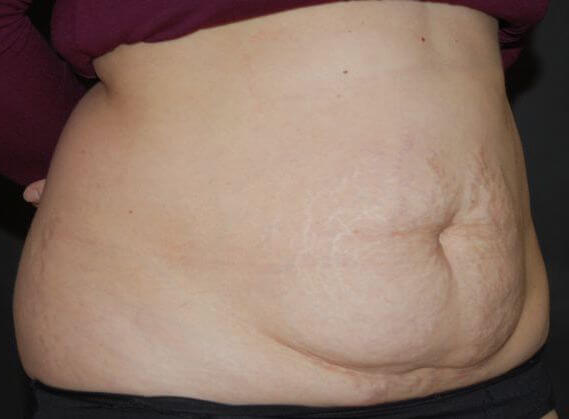 Before Tummy Tuck & Abdominoplasty Christian-West