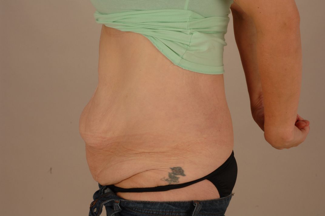 Before Tummy Tuck & Abdominoplasty Christian-West