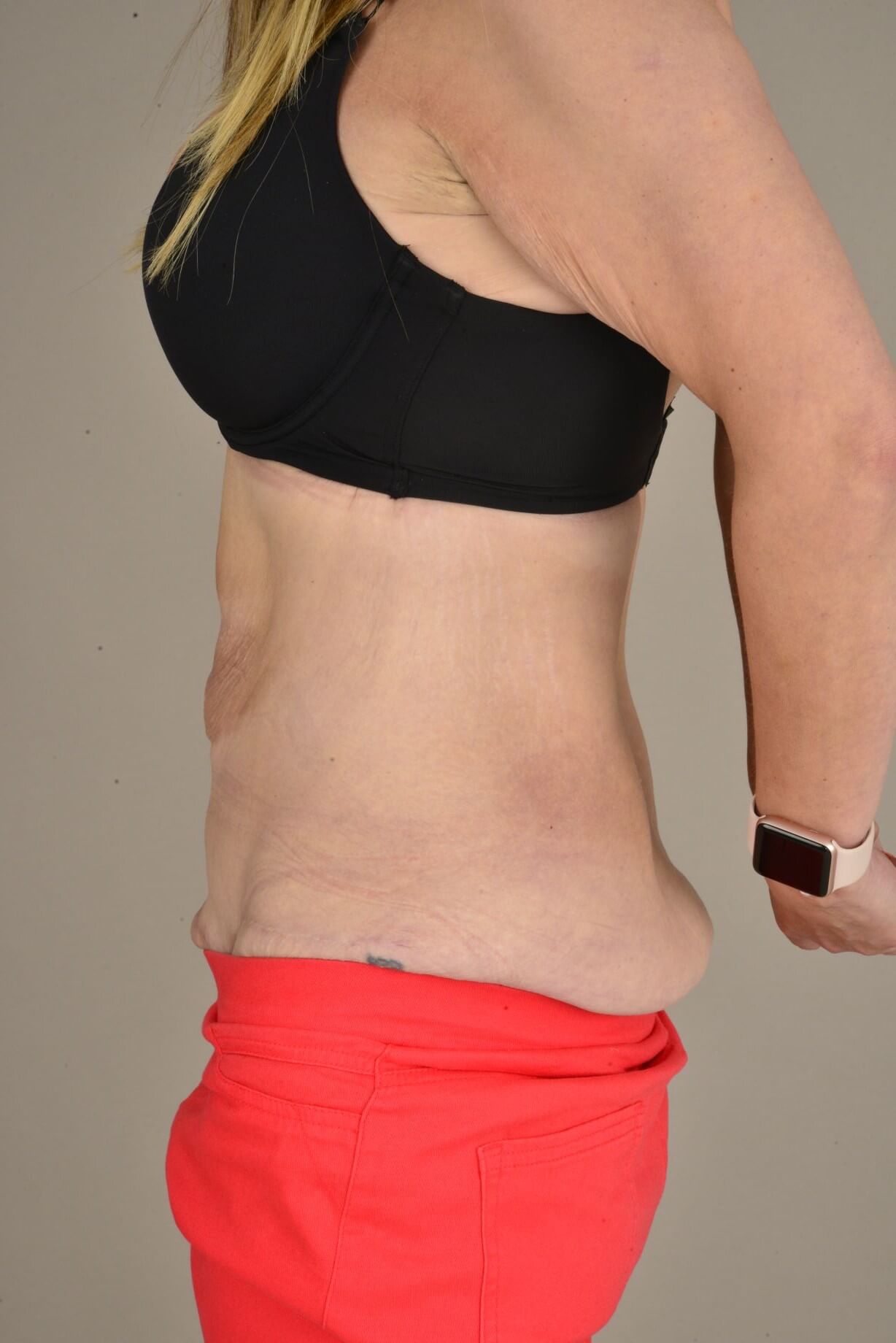 Tummy Tuck & Abdominoplasty Christian West