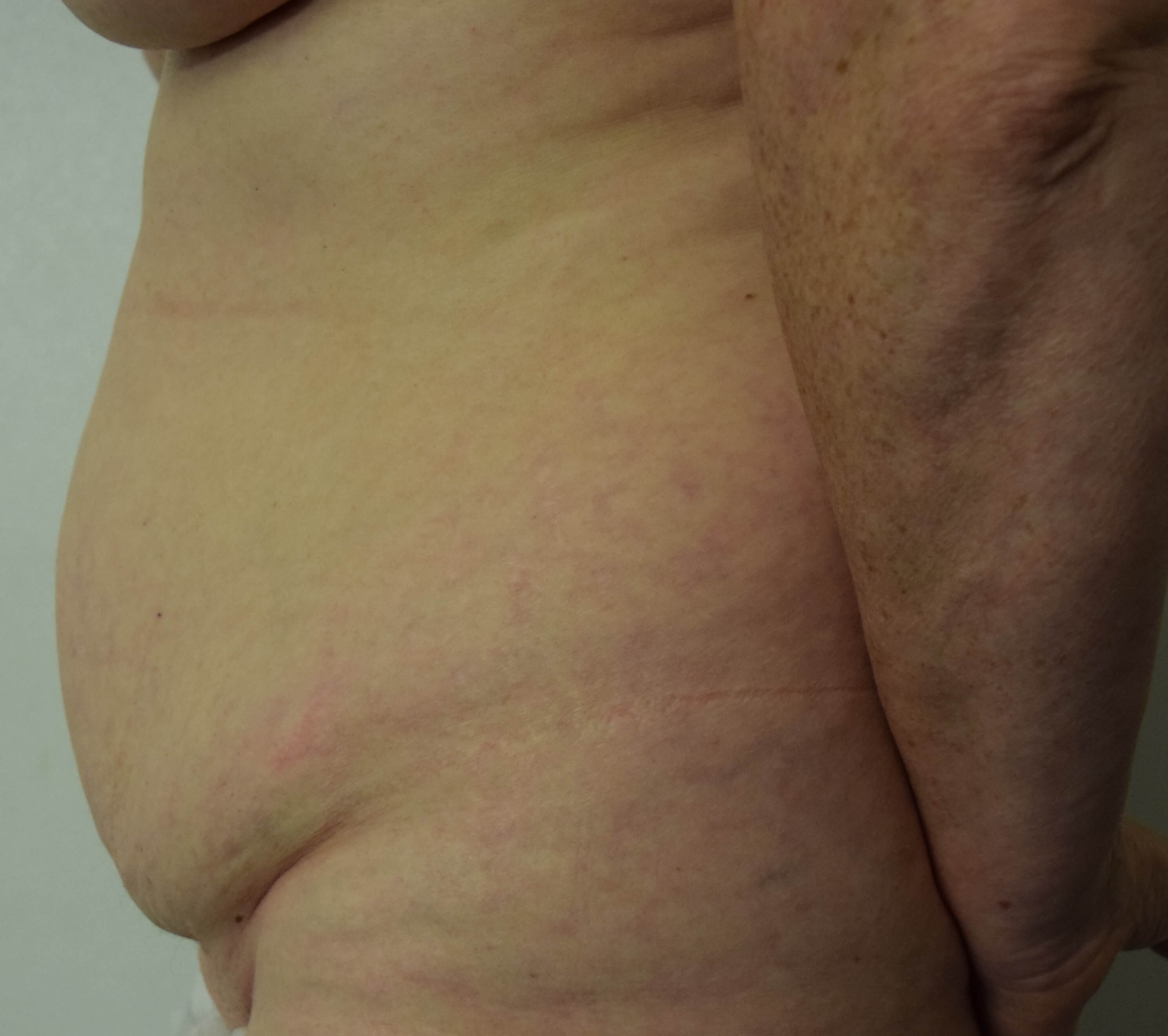 Before Tummy Tuck & Abdominoplasty Christian-West