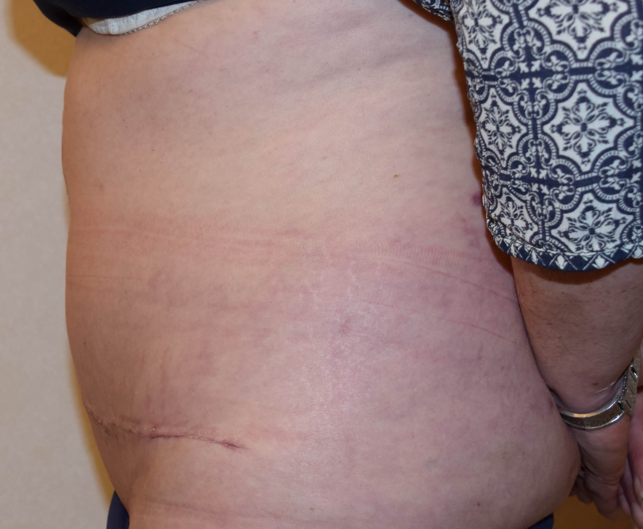 Tummy Tuck & Abdominoplasty Christian West