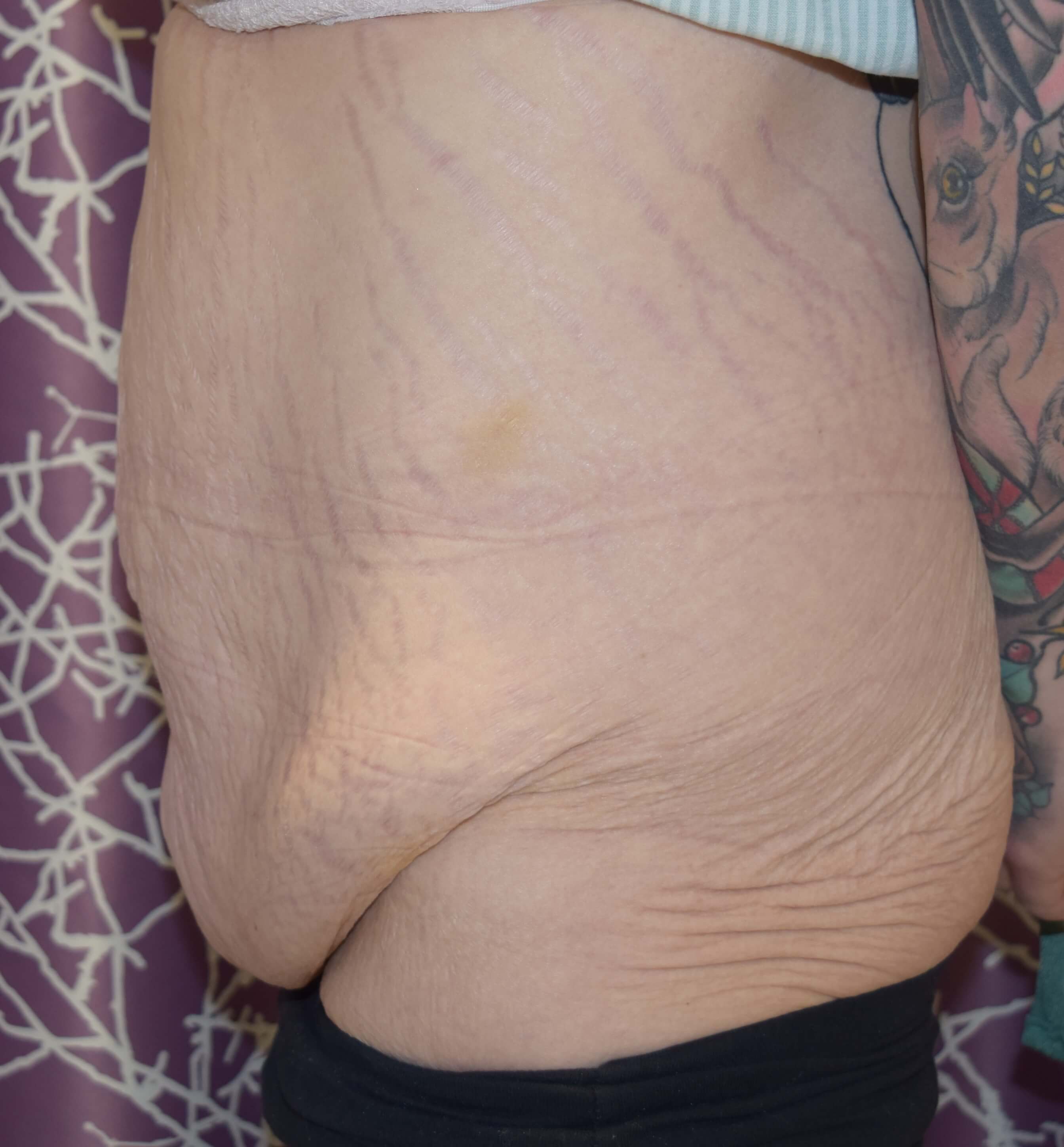 Before Tummy Tuck & Abdominoplasty Christian-West