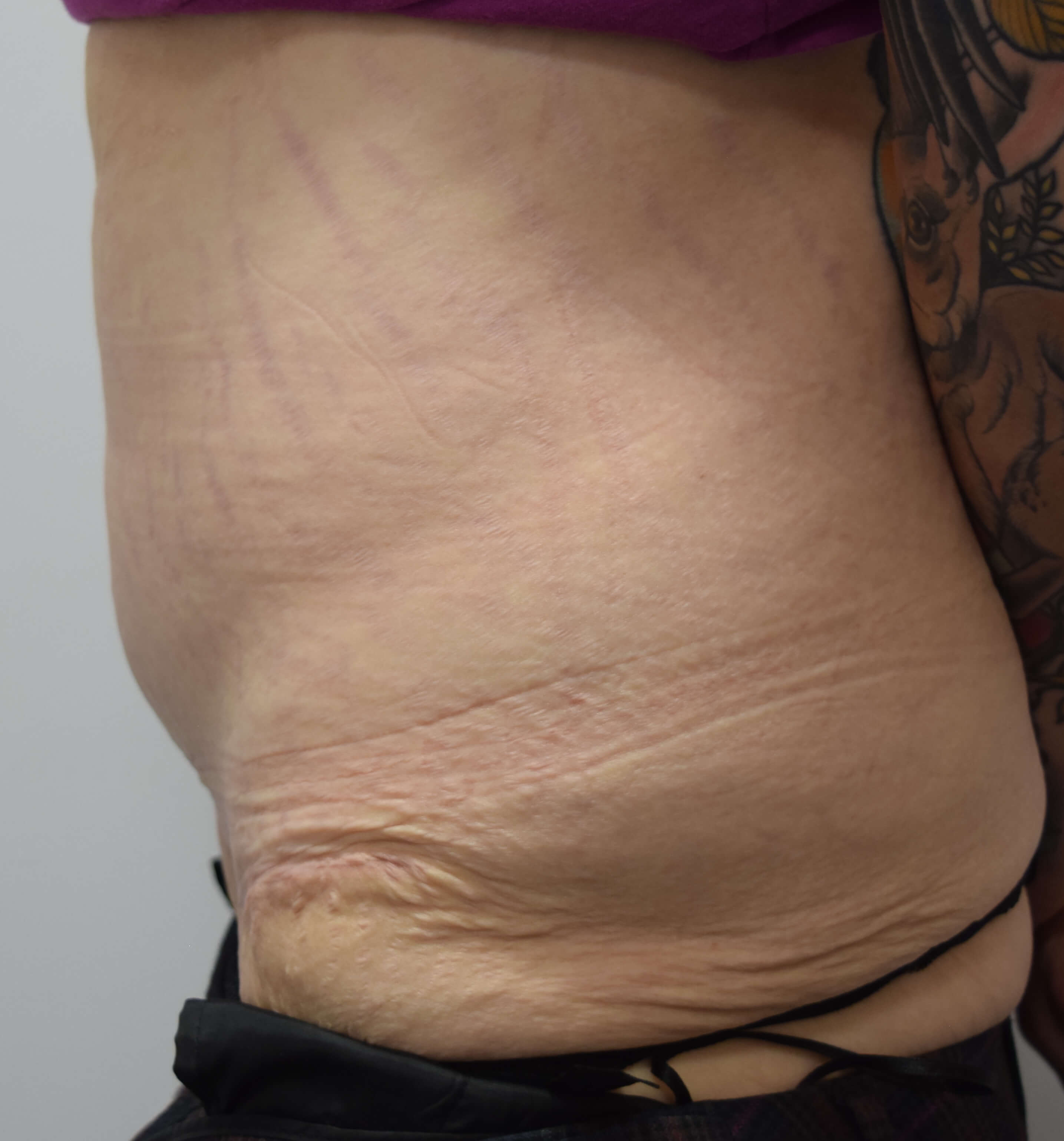 Tummy Tuck & Abdominoplasty Christian West