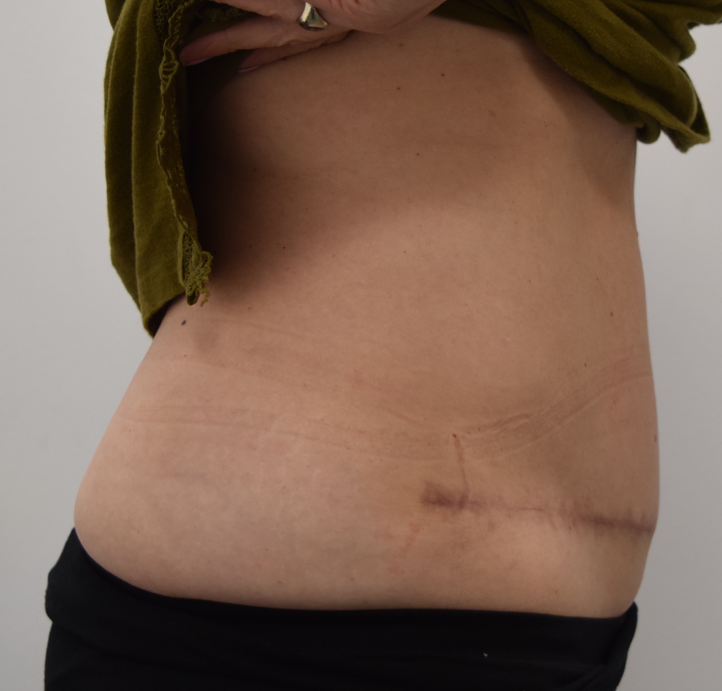 Tummy Tuck & Abdominoplasty Christian West