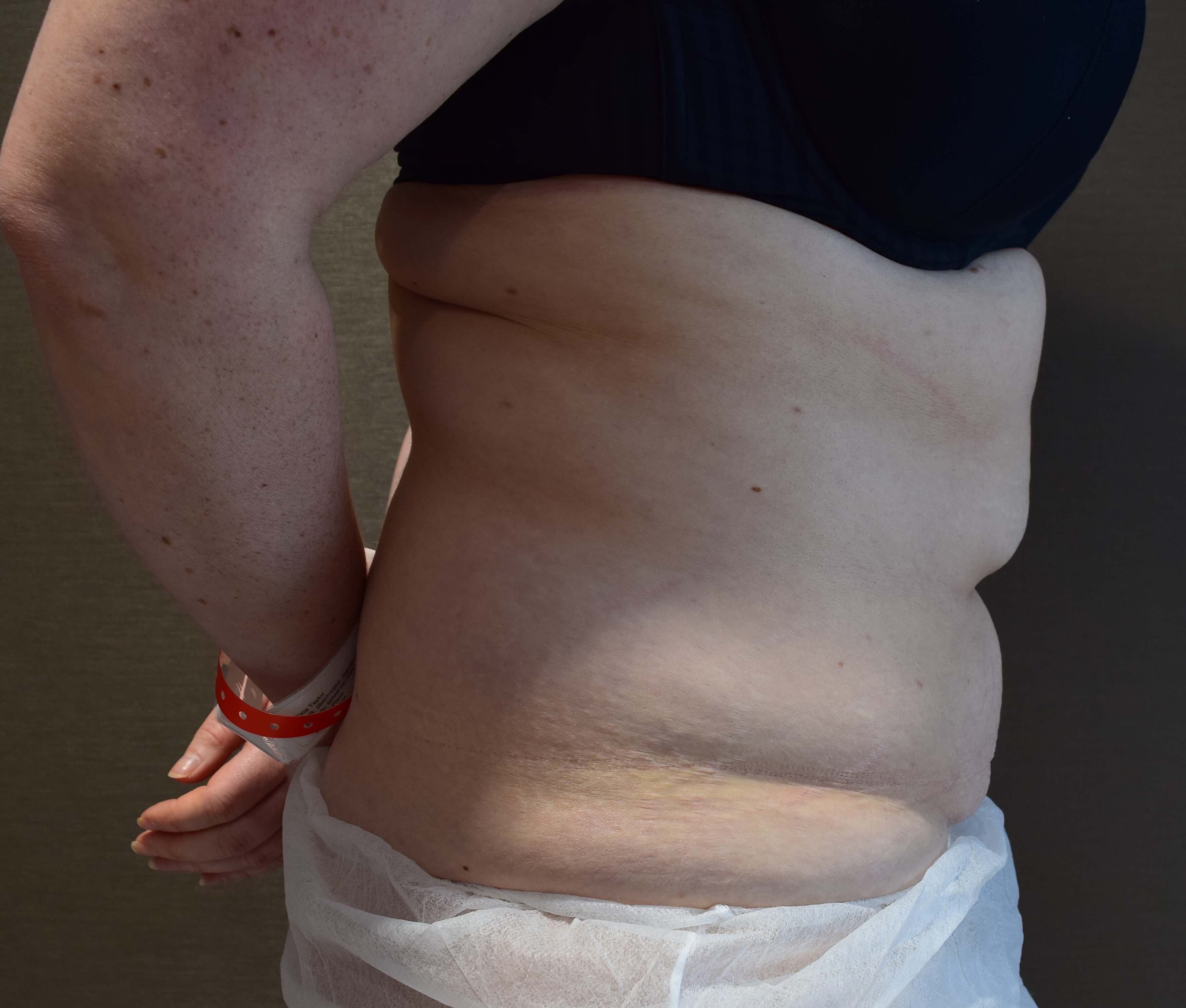 Before Tummy Tuck & Abdominoplasty Christian-West