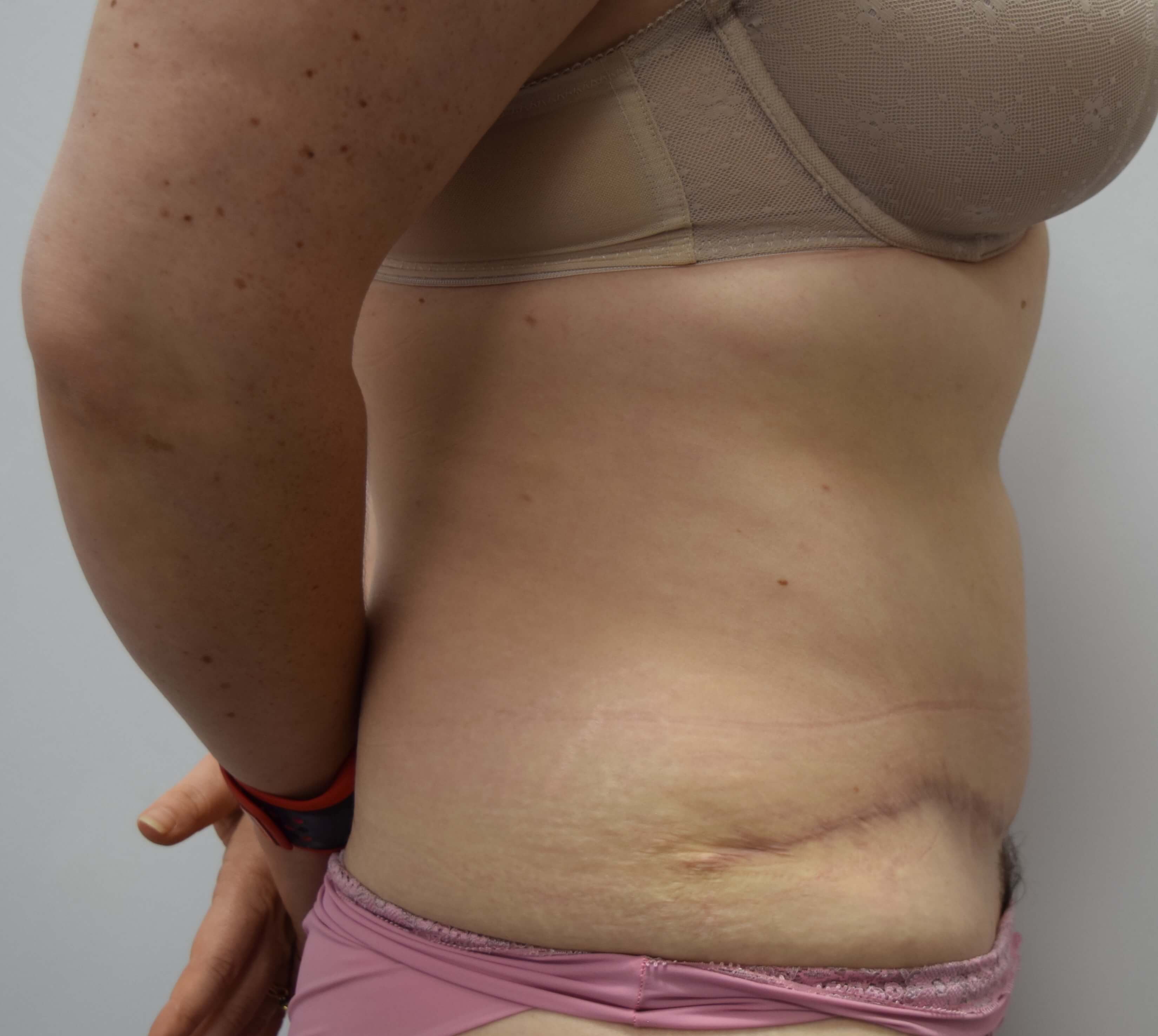 Tummy Tuck & Abdominoplasty Christian West