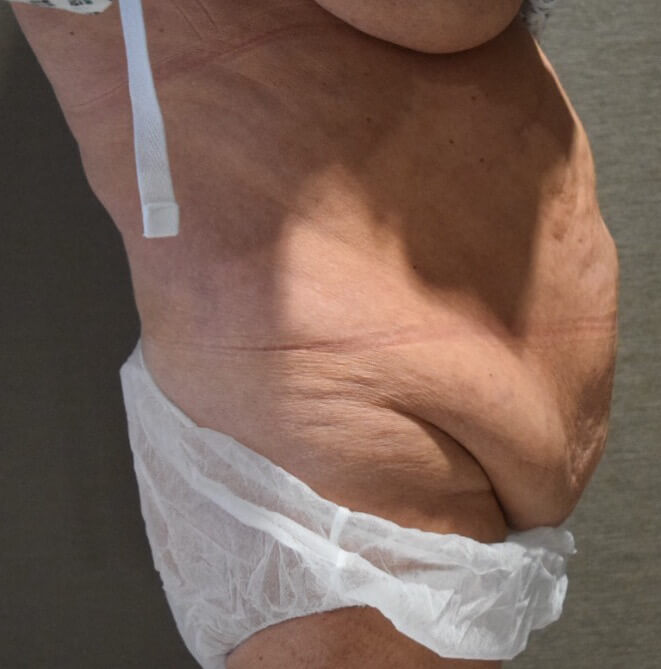 Before Tummy Tuck & Abdominoplasty Christian-West