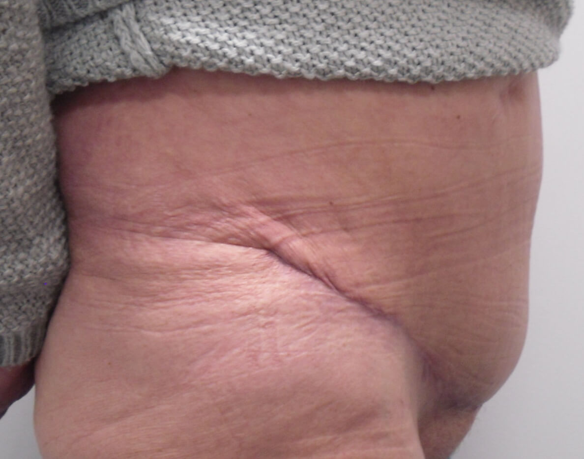 Tummy Tuck & Abdominoplasty Christian West